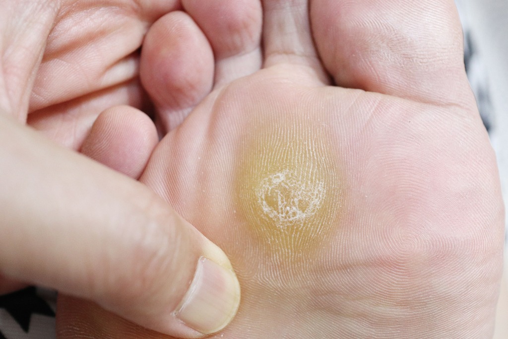 foot skin callus