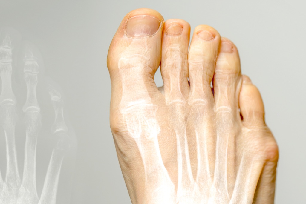 X-ray and the same foot. Hallux varus condition