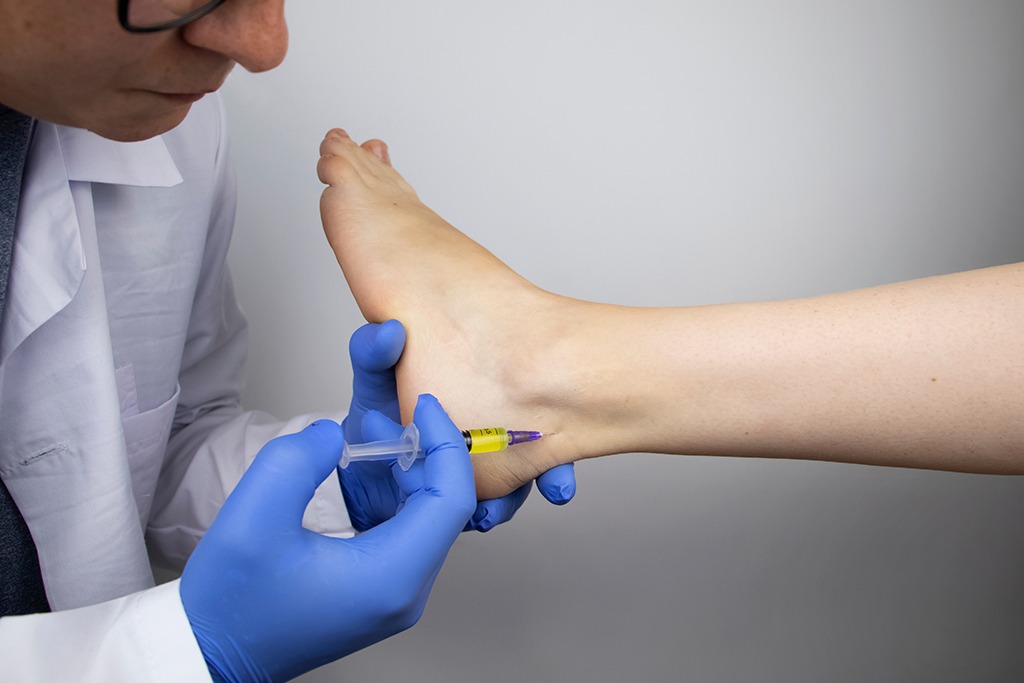An orthopedic surgeon injects medicine into the Achilles tendon