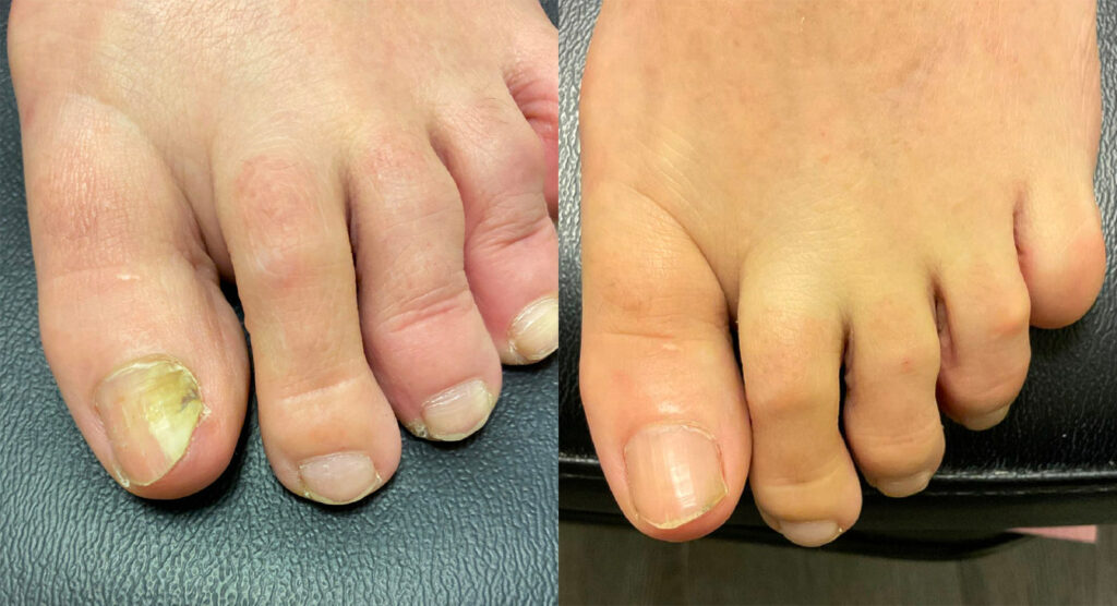 Toenail Fungus Before and After Photo by Oregon Institute of Foot Care in Lake Oswego OR