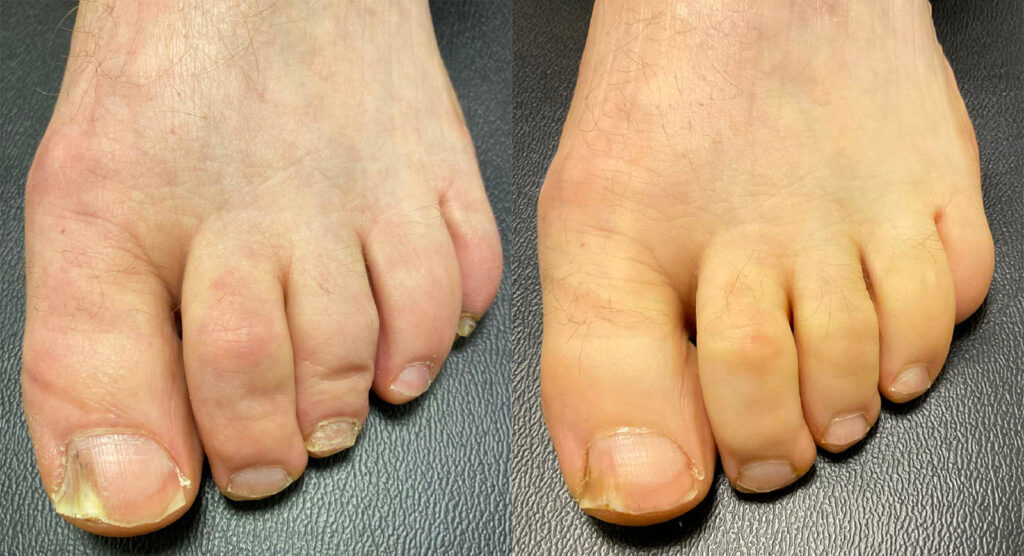 Toenail Fungus Before and After Photo by Oregon Institute of Foot Care in Lake Oswego OR