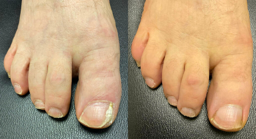 Toenail Fungus Before and After Photo by Oregon Institute of Foot Care in Lake Oswego OR