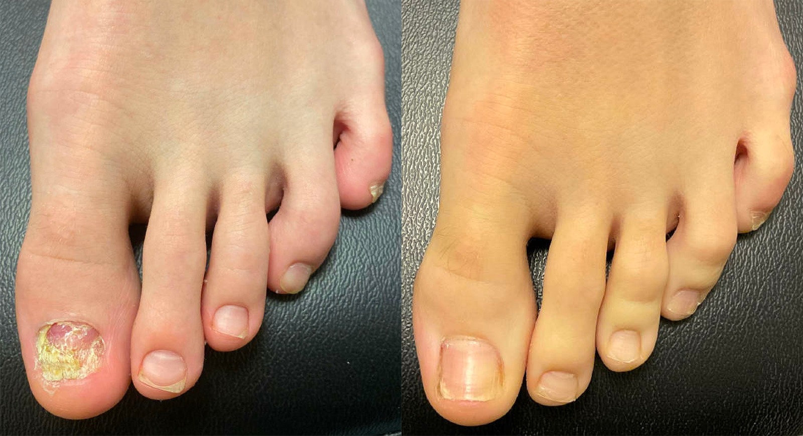 Toenail Fungus Before and After Photo by Oregon Institute of Foot Care in Lake Oswego OR