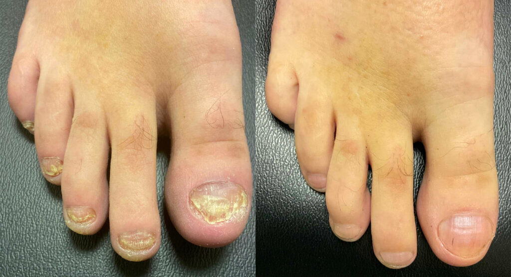 Toenail Fungus Before and After Photo by Oregon Institute of Foot Care in Lake Oswego OR