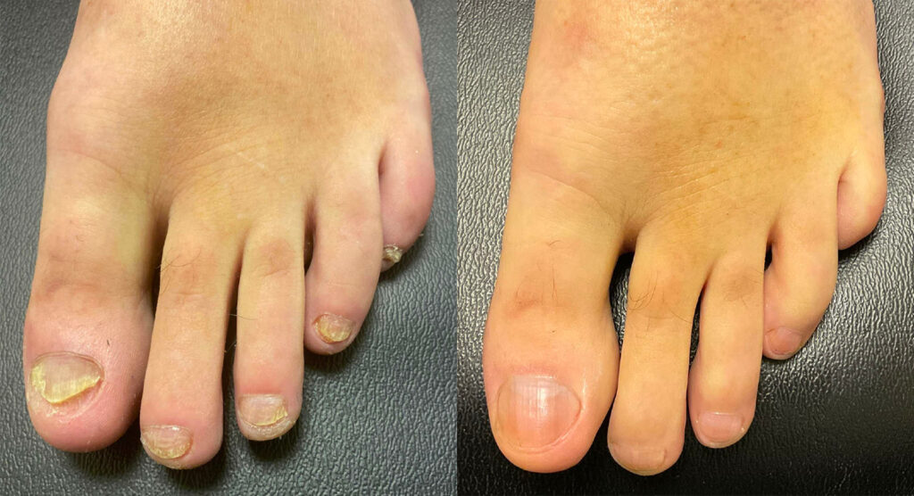Toenail Fungus Before and After Photo by Oregon Institute of Foot Care in Lake Oswego OR