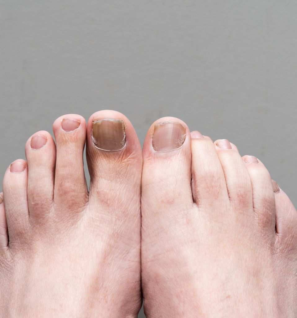 Male Feet onychomycosis with fungal infection