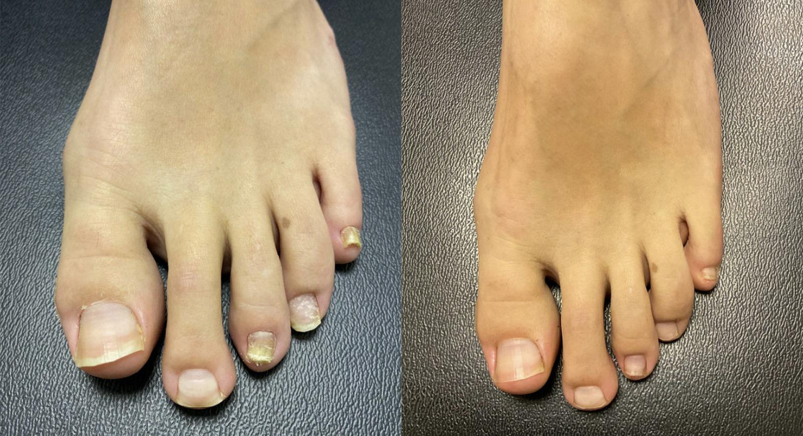 Toenail Fungus Before and After Photo by Oregon Institute of Foot Care in Lake Oswego OR