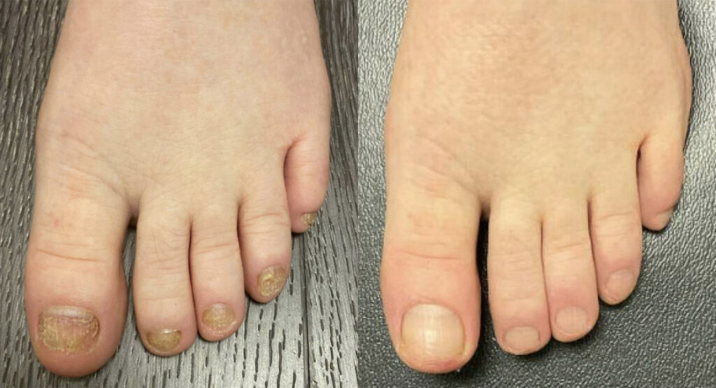 Toenail Fungus Before and After Photo by Oregon Institute of Foot Care in Lake Oswego OR