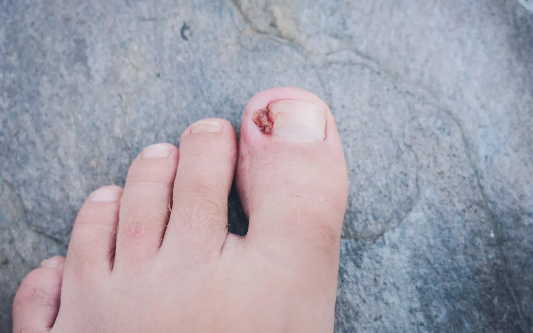 Onyfix vs. Ingrown Toenail Surgery: Which Treatment Is Right for You