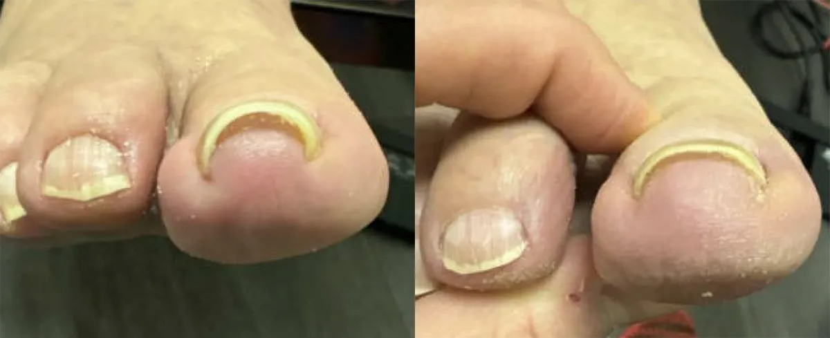 Onyfix ingrown toenails Before and After Photo