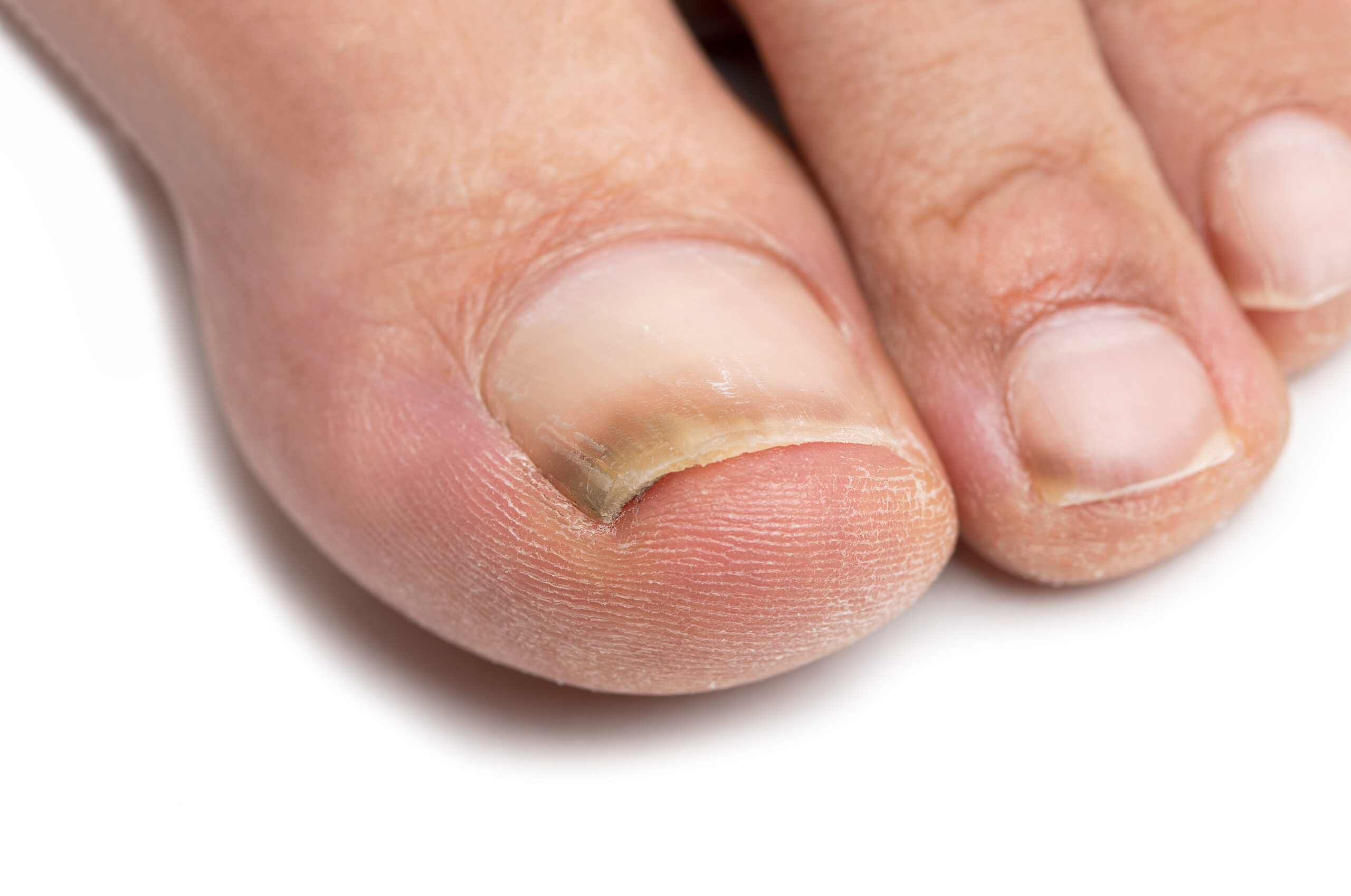 big; care; chiropody; closeup; disease; finger; foot; fungal; fungus; infection; male; man; nail; onychomycosis; podiatry; podologist; ringworm; skin; tinea; toe; toenail; treatment